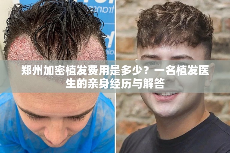 郑州加密植发费用是多少？一名植发医生的亲身经历与解答