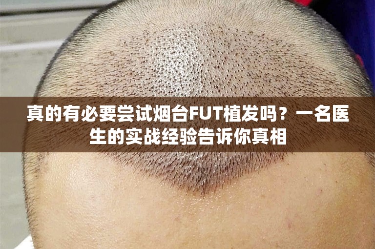 真的有必要尝试烟台FUT植发吗？一名医生的实战经验告诉你真相