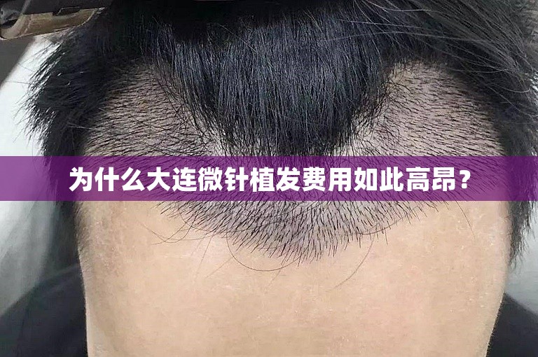 为什么大连微针植发费用如此高昂？