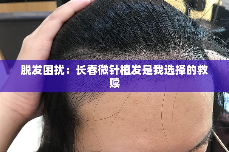 脱发困扰：长春微针植发是我选择的救赎