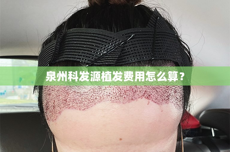 泉州科发源植发费用怎么算？