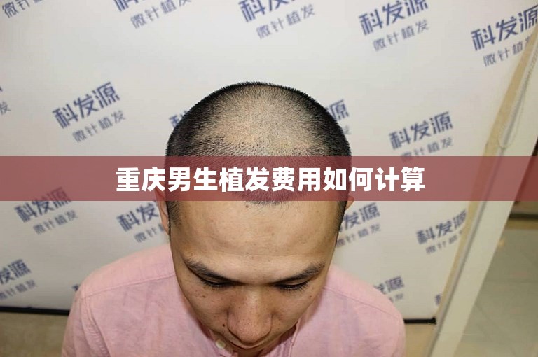 重庆男生植发费用如何计算