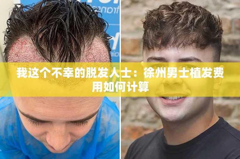 我这个不幸的脱发人士：徐州男士植发费用如何计算