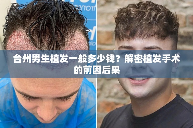 台州男生植发一般多少钱？解密植发手术的前因后果