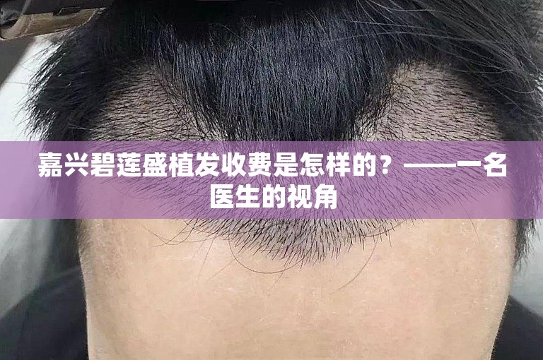 嘉兴碧莲盛植发收费是怎样的？——一名医生的视角