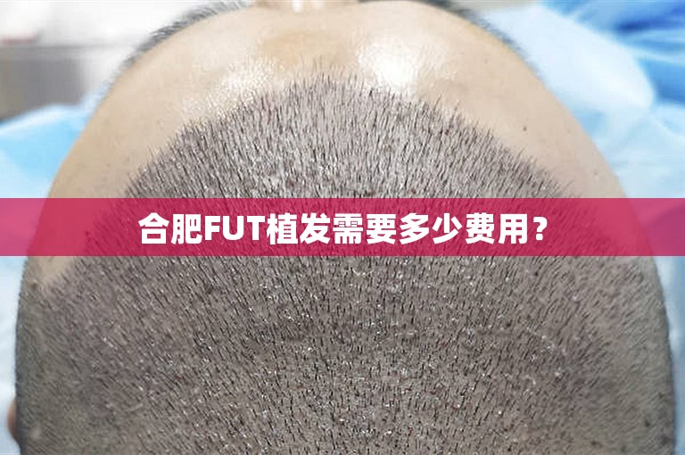 合肥FUT植发需要多少费用？