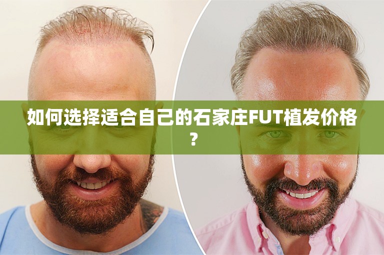 如何选择适合自己的石家庄FUT植发价格？