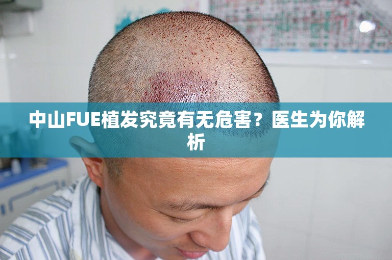 中山FUE植发究竟有无危害？医生为你解析