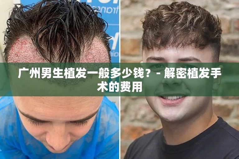 广州男生植发一般多少钱？- 解密植发手术的费用