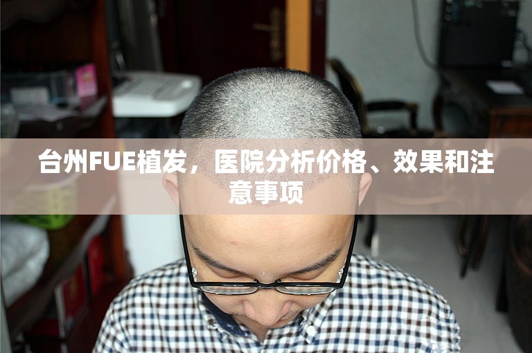 台州FUE植发，医院分析价格、效果和注意事项