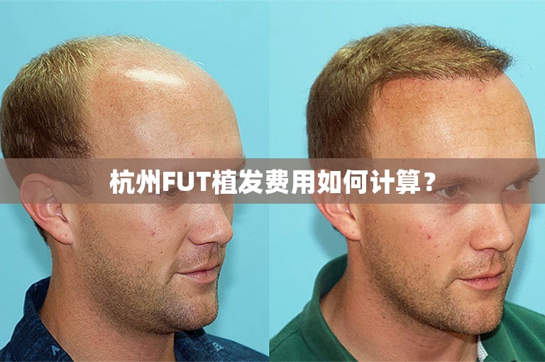 杭州FUT植发费用如何计算？