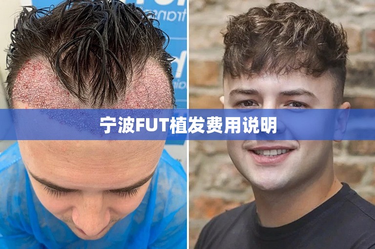 宁波FUT植发费用说明