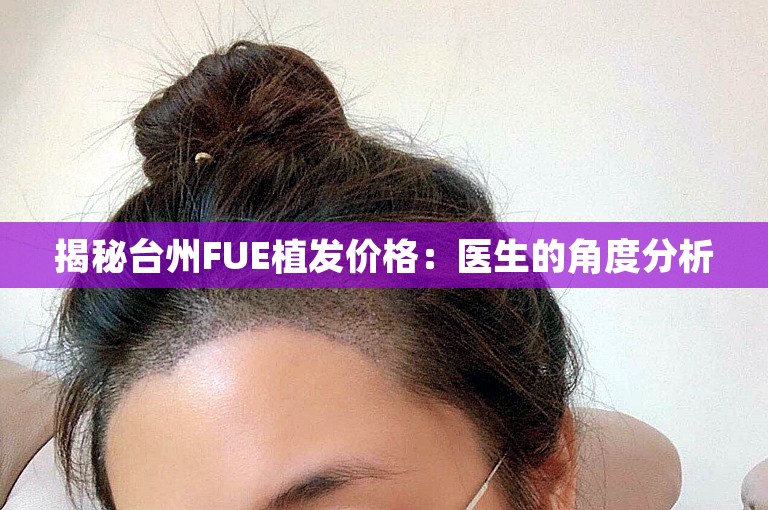 揭秘台州FUE植发价格：医生的角度分析