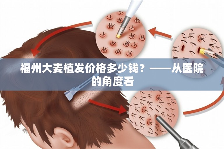 福州大麦植发价格多少钱？——从医院的角度看