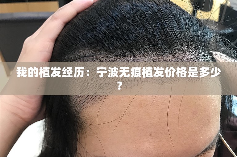 我的植发经历：宁波无痕植发价格是多少？