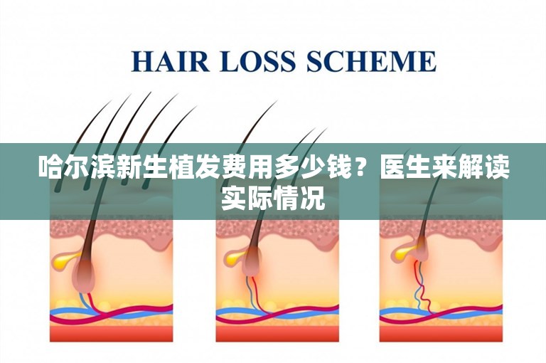 哈尔滨新生植发费用多少钱？医生来解读实际情况