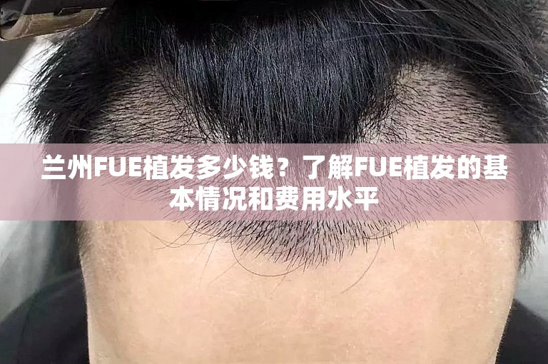 兰州FUE植发多少钱？了解FUE植发的基本情况和费用水平