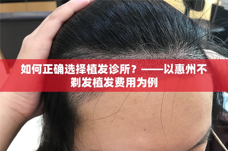 如何正确选择植发诊所？——以惠州不剃发植发费用为例