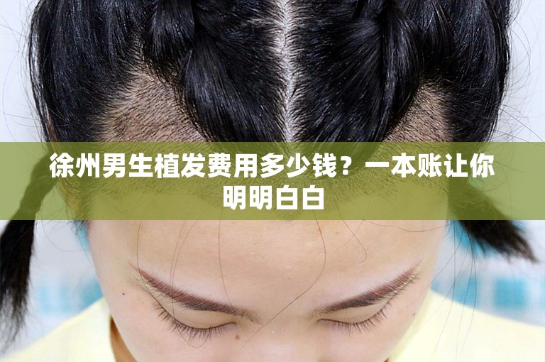 徐州男生植发费用多少钱？一本账让你明明白白