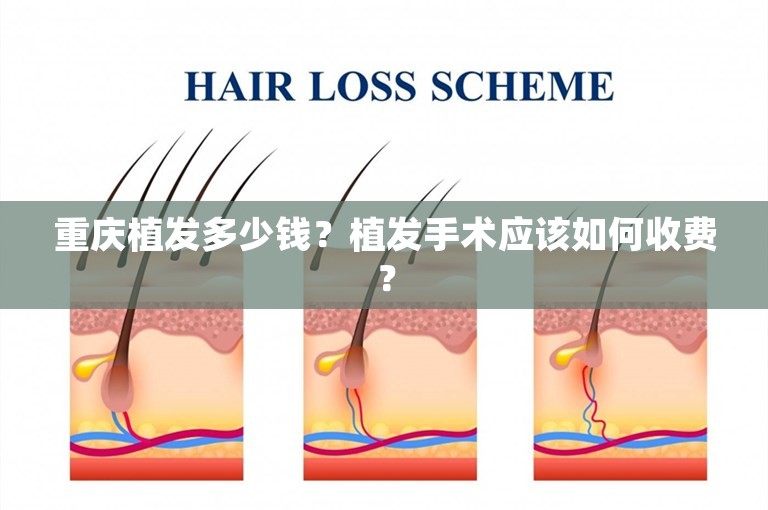 重庆植发多少钱？植发手术应该如何收费？