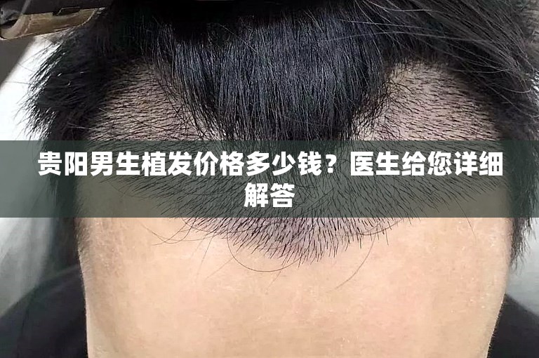 贵阳男生植发价格多少钱？医生给您详细解答