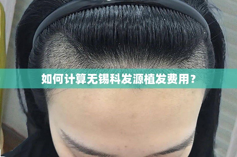 如何计算无锡科发源植发费用？