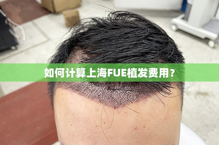 如何计算上海FUE植发费用？