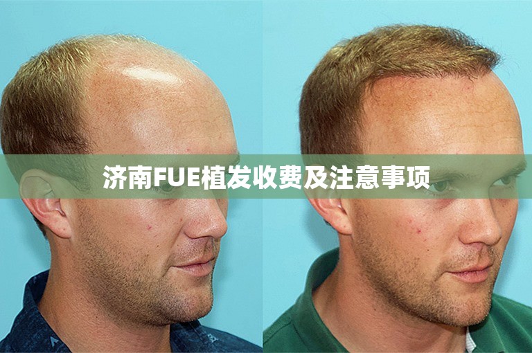 济南FUE植发收费及注意事项