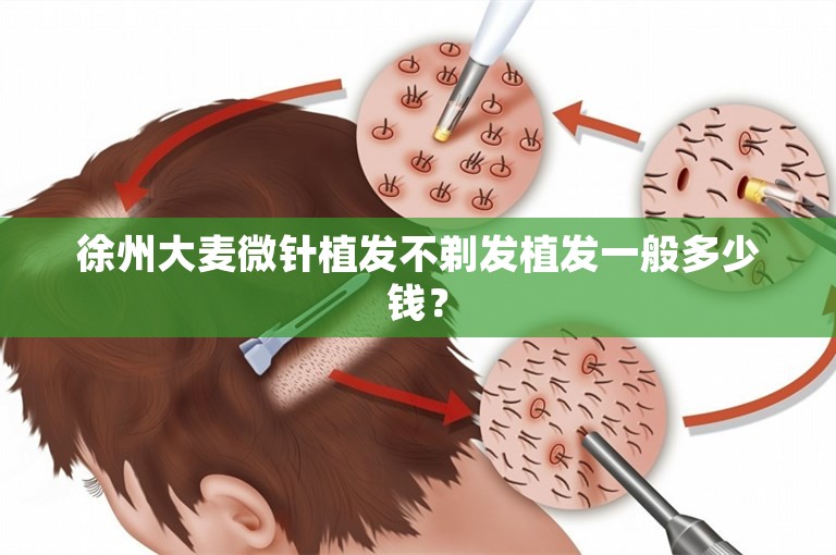 徐州大麦微针植发不剃发植发一般多少钱？