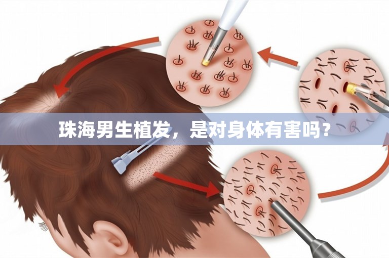 珠海男生植发，是对身体有害吗？