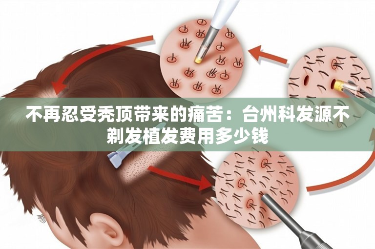 不再忍受秃顶带来的痛苦：台州科发源不剃发植发费用多少钱