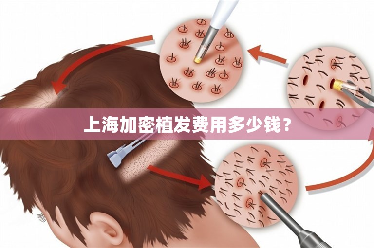 上海加密植发费用多少钱？