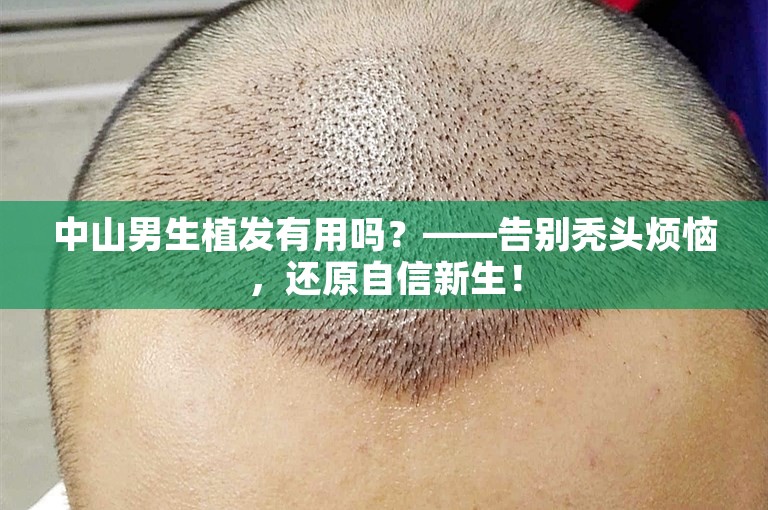 中山男生植发有用吗？——告别秃头烦恼，还原自信新生！