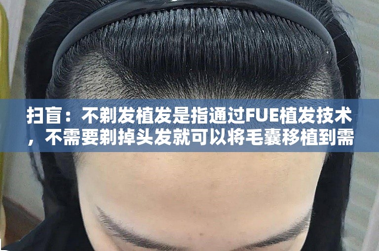 扫盲：不剃发植发是指通过FUE植发技术，不需要剃掉头发就可以将毛囊移植到需要生发的部位