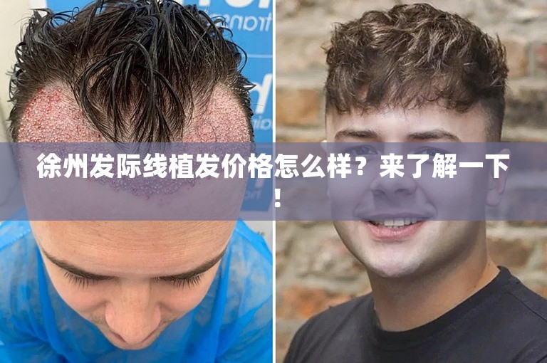 徐州发际线植发价格怎么样？来了解一下！