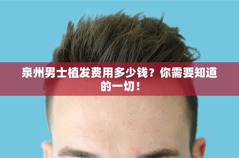 泉州男士植发费用多少钱？你需要知道的一切！