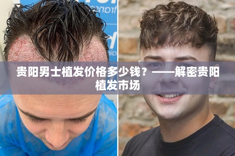 贵阳男士植发价格多少钱？——解密贵阳植发市场