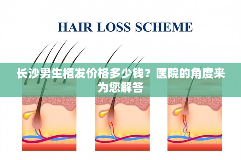 长沙男生植发价格多少钱？医院的角度来为您解答