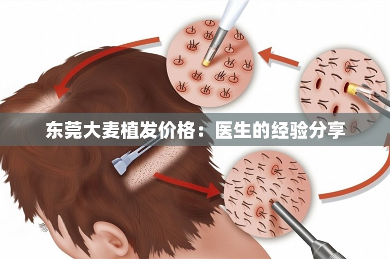 东莞大麦植发价格：医生的经验分享