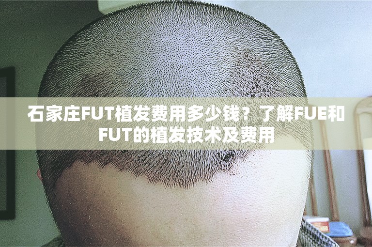 石家庄FUT植发费用多少钱？了解FUE和FUT的植发技术及费用