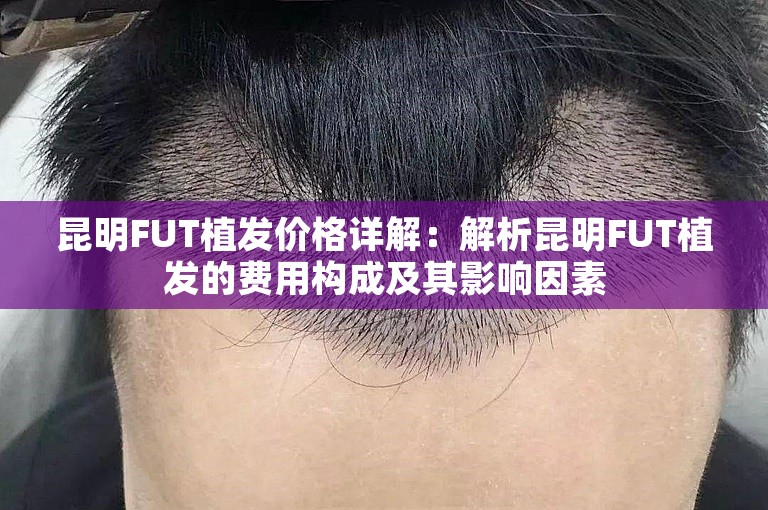 昆明FUT植发价格详解：解析昆明FUT植发的费用构成及其影响因素