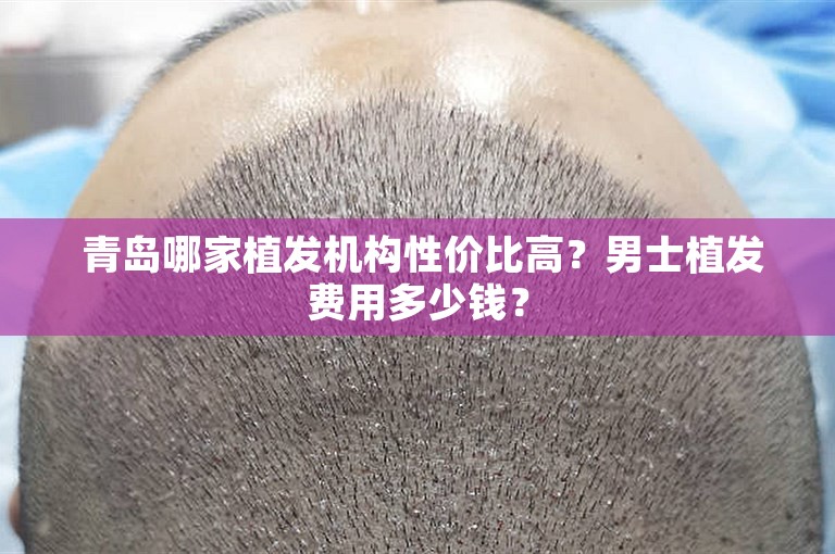  青岛哪家植发机构性价比高？男士植发费用多少钱？