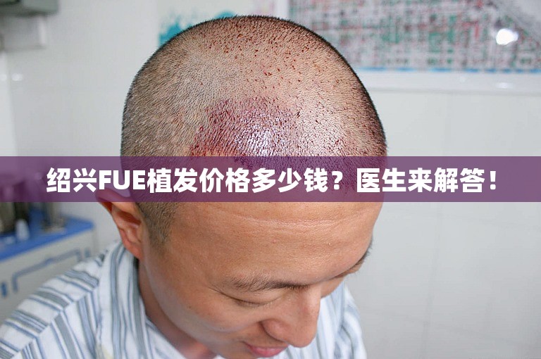 绍兴FUE植发价格多少钱？医生来解答！