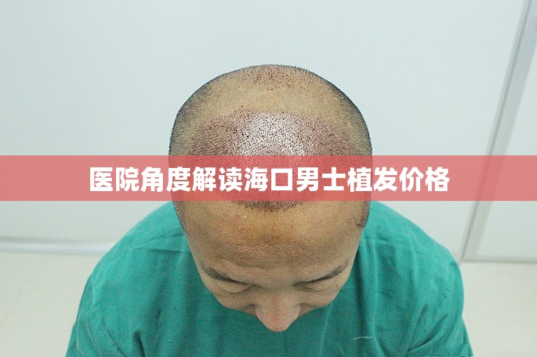 医院角度解读海口男士植发价格