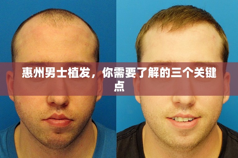 惠州男士植发，你需要了解的三个关键点