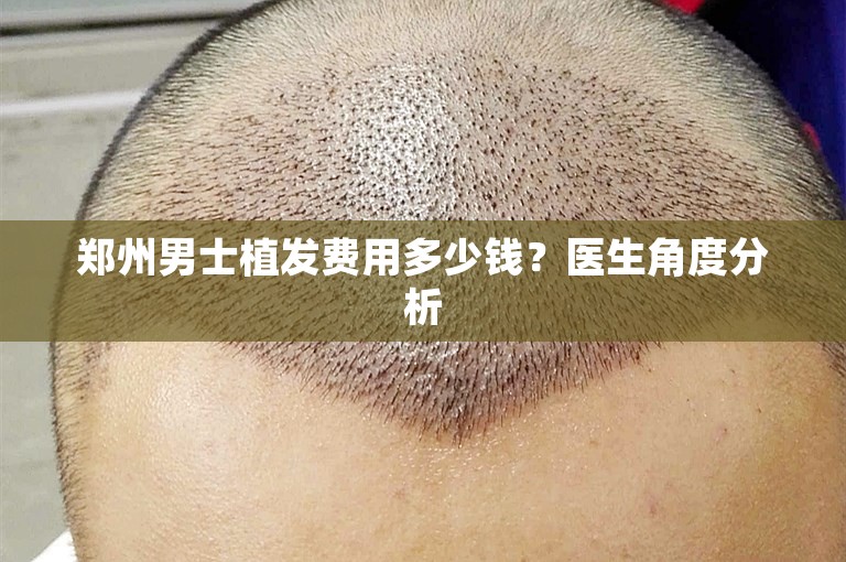 郑州男士植发费用多少钱？医生角度分析