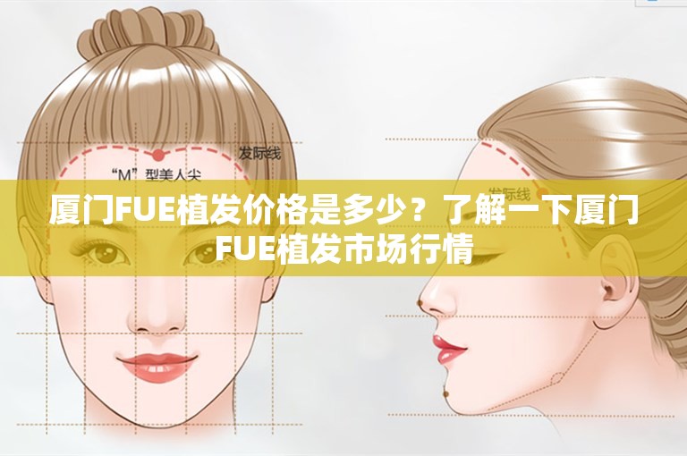 厦门FUE植发价格是多少？了解一下厦门FUE植发市场行情