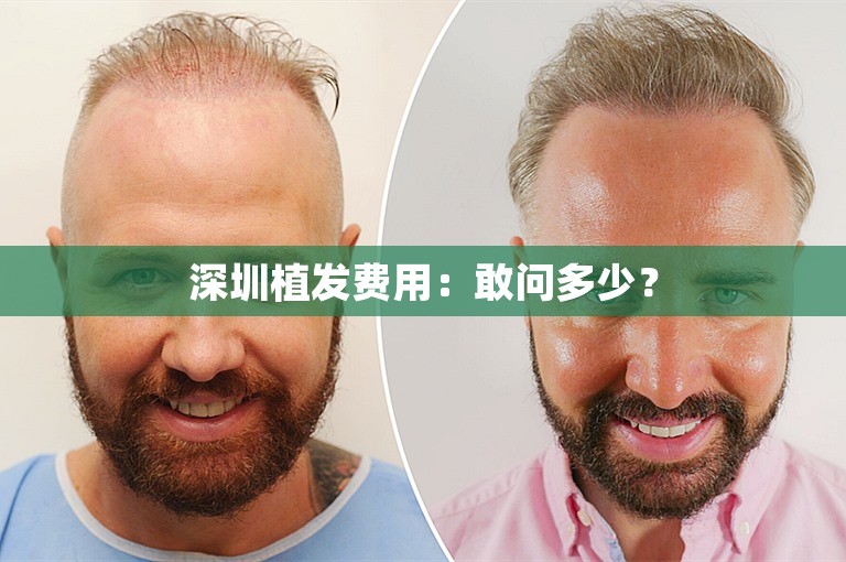 深圳植发费用：敢问多少？