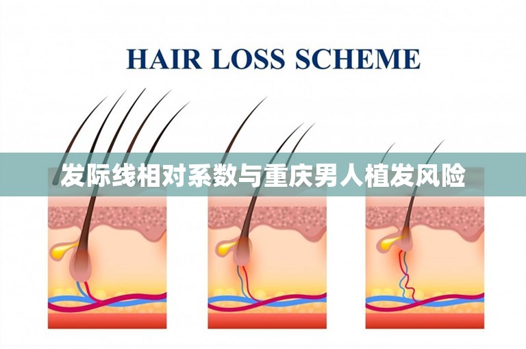 发际线相对系数与重庆男人植发风险