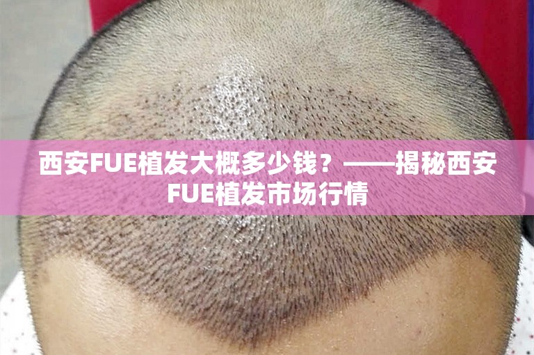 西安FUE植发大概多少钱？——揭秘西安FUE植发市场行情